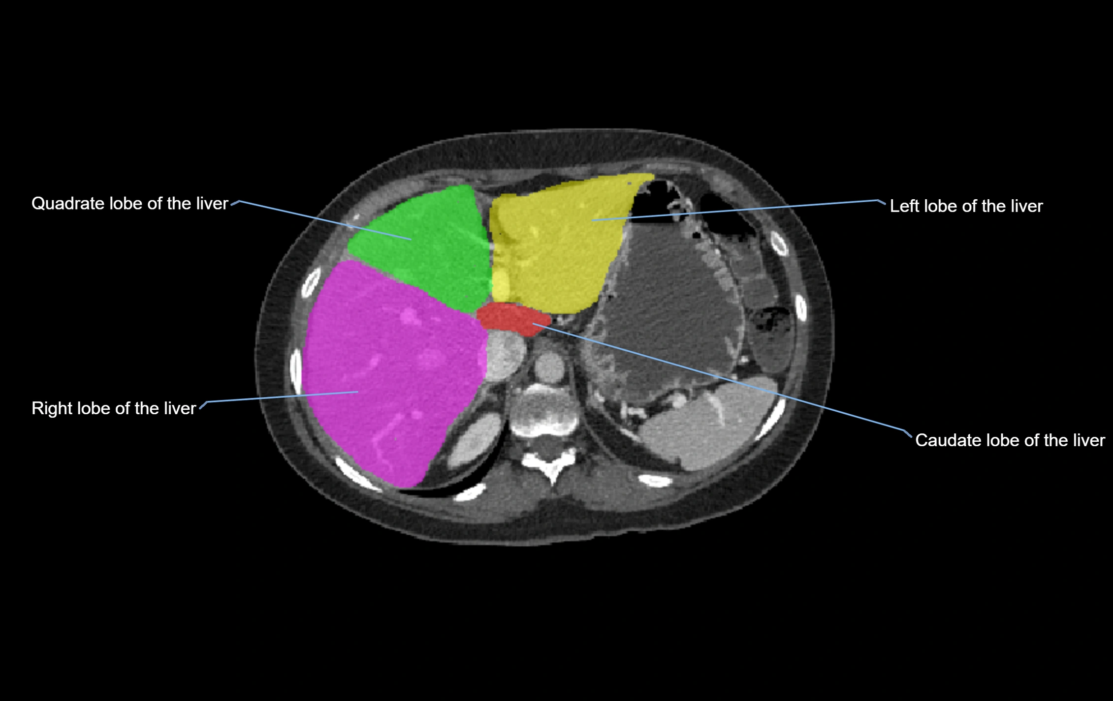 CT lliver lobes axial cross sectional anatomy labelled image -00052.webp